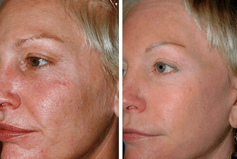 pirms un pēc frakcionētas ādas atjaunošanas foto 1