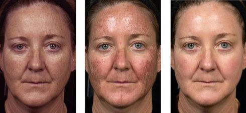 pirms un pēc frakcionētas ādas atjaunošanas foto 2