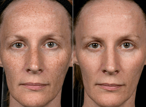 pirms un pēc frakcionētas ādas atjaunošanas foto 3