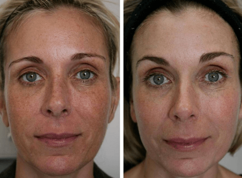 pirms un pēc frakcionētas ādas atjaunošanas foto 4