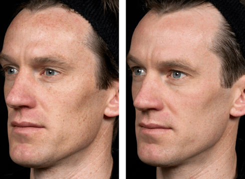 pirms un pēc frakcionētas ādas atjaunošanas foto 5