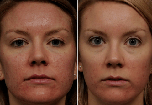 pirms un pēc frakcionētas ādas atjaunošanas foto 6