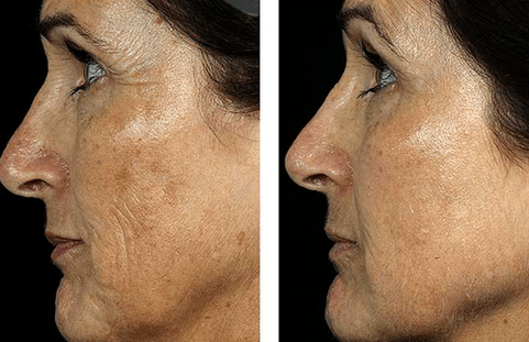 pirms un pēc frakcionētas ādas atjaunošanas foto 7