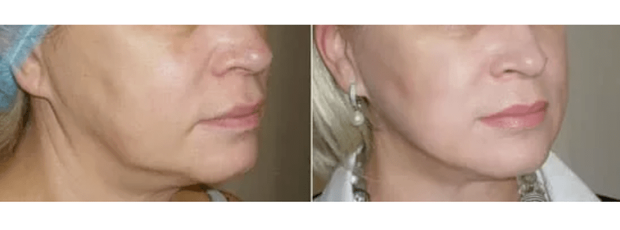 atveseļošanās pēc ādas atjaunošanas