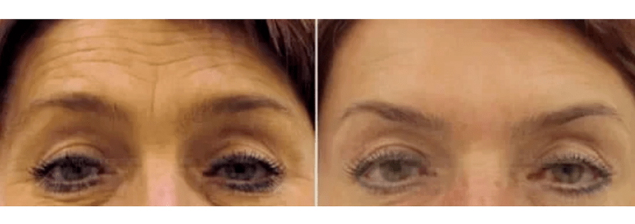 ierīces frakcionētai atjaunošanai